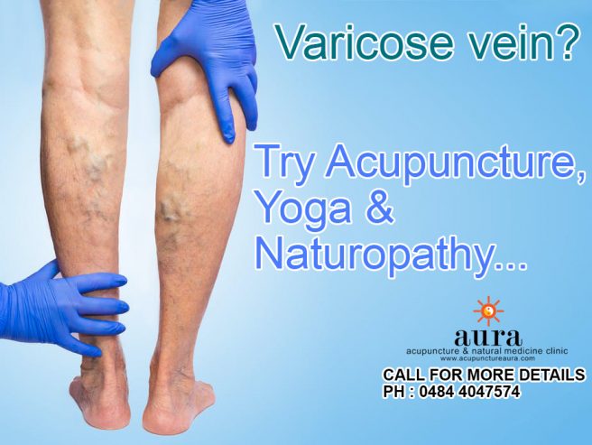Treatment for Varicose vein